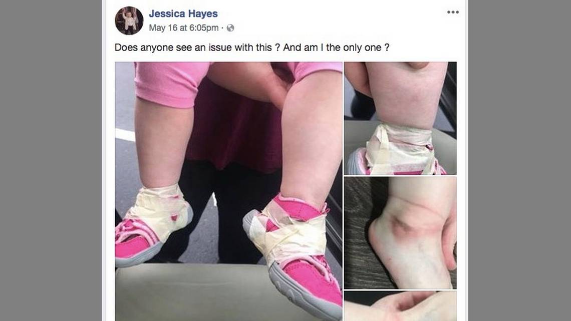 Daycare Worker Fired For Taping Toddler's Shoes To Her Ankles, Cutting Off Circulation